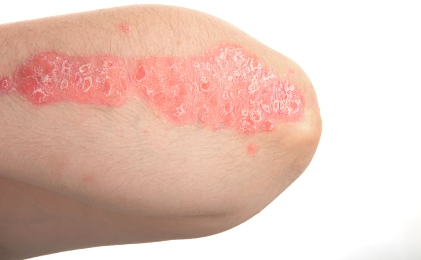 Red inflamed dry skin on elbow