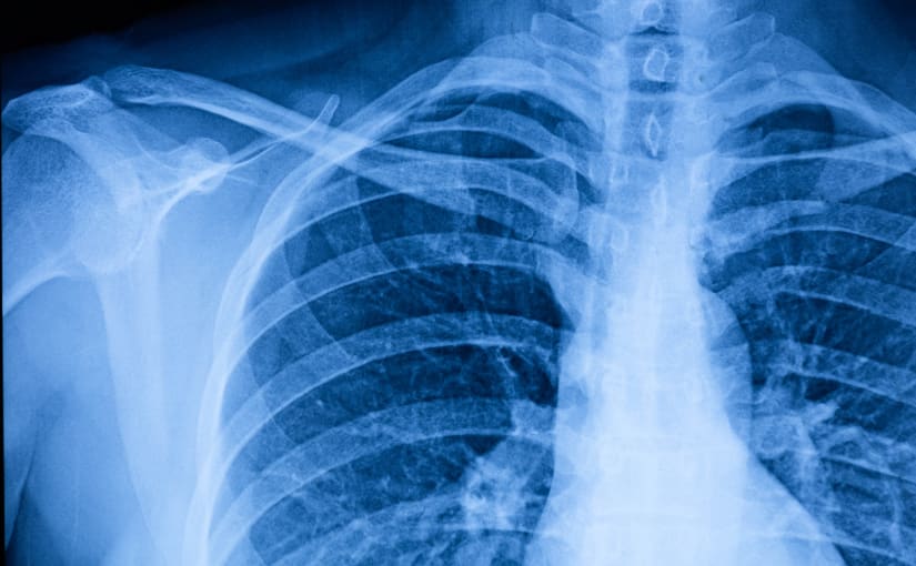 X-ray of a chest