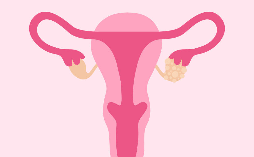 Illustration of ovarian cysts
