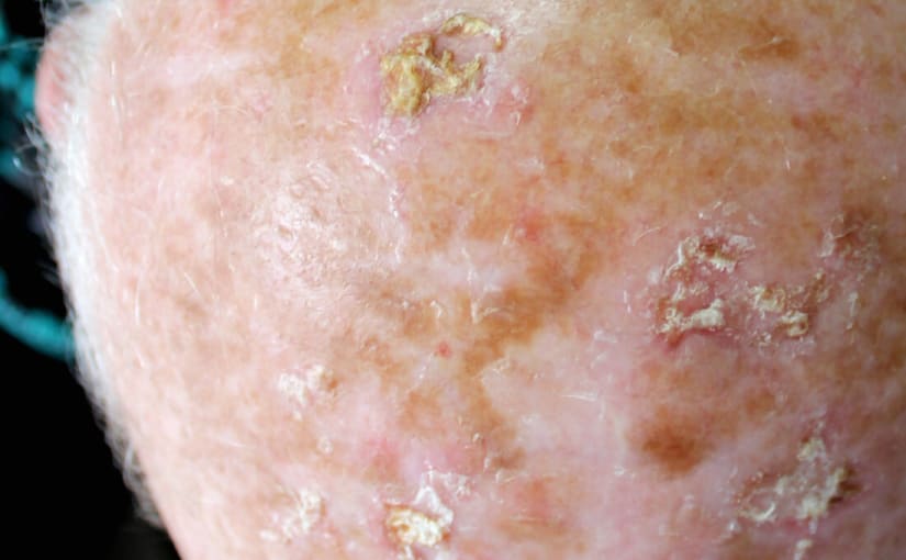  Actinic keratoses afflicted skin