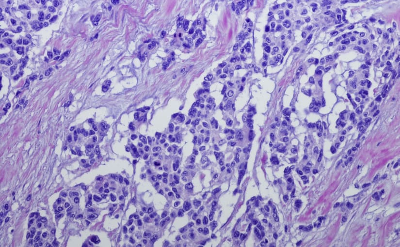 Micrograph of Rhabdomyosarcoma RMS